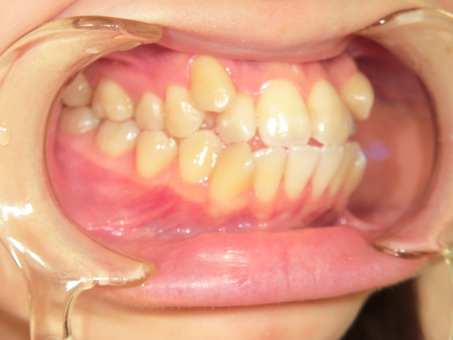 【矯正症例】八重歯　上下前歯部叢生