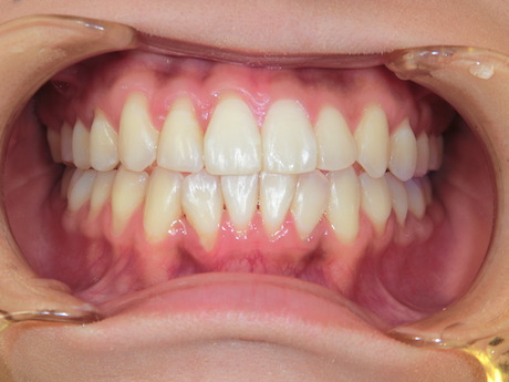 【矯正症例】前歯受け口　上下前歯部叢生