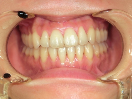 【矯正症例】前歯でモノが噛めない　前歯部開口