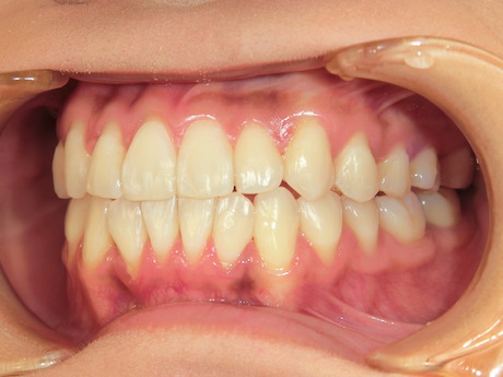 【矯正症例】前歯受け口　上下前歯部叢生