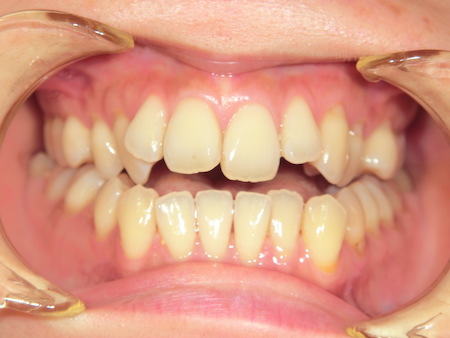【矯正症例】前歯でモノが噛めない　前歯部開口