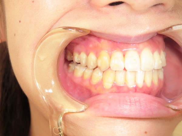 【矯正症例】前歯をそろえたい　前歯部叢生、開口