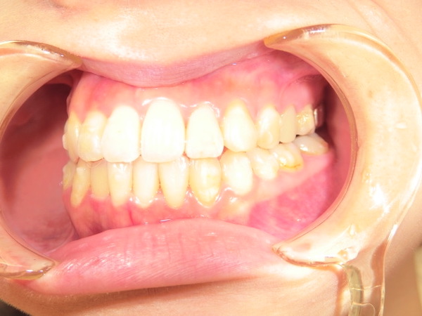 【矯正症例】前歯をそろえたい　前歯部叢生、開口
