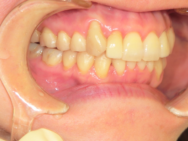 【矯正症例】八重歯　前歯部叢生