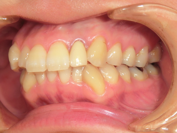 【矯正症例】八重歯　前歯部叢生
