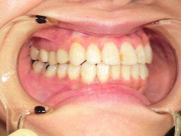 【矯正症例】前歯が出ている　前歯部前突