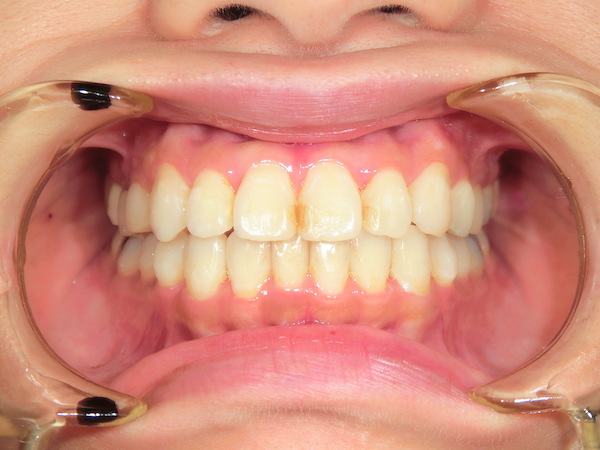 【矯正症例】前歯が出ている　前歯部前突