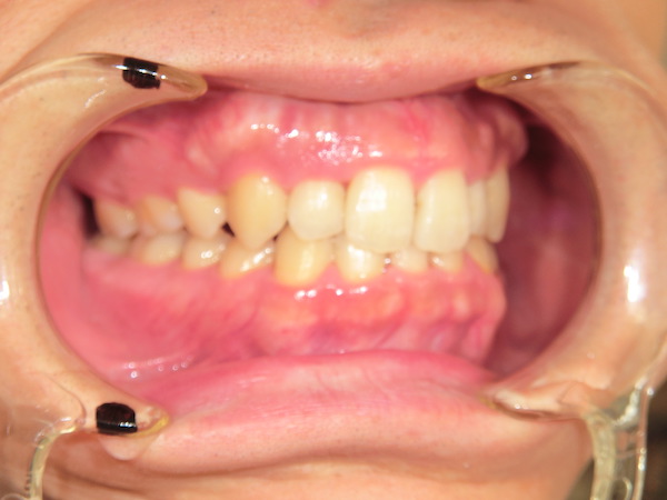 【矯正症例】前歯の乱杭を直したい　上下前歯部叢生
