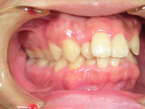 【矯正症例】前歯の乱杭を直したい　上下前歯部叢生