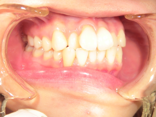 【矯正症例】前歯の乱杭を直したい　前歯部叢生