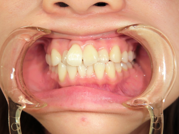 【矯正症例】前歯の乱杭を直したい　前歯部叢生