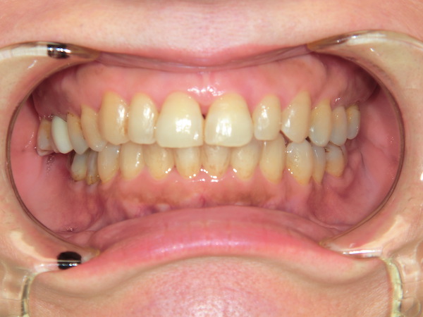 【矯正症例】歯並びをよくしたい　歯の叢生