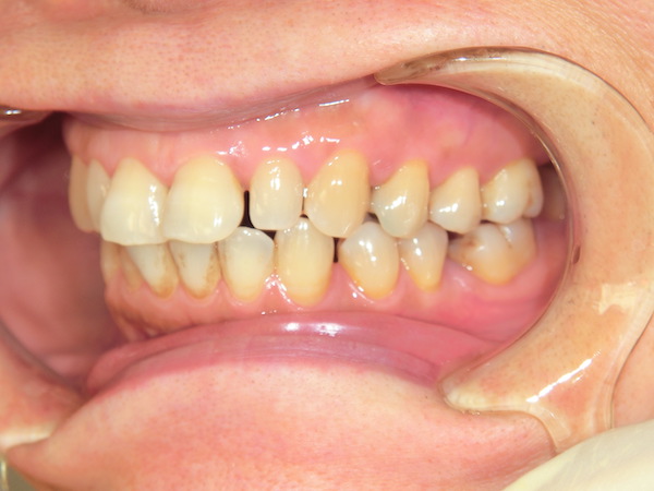 【矯正症例】歯並びをよくしたい　歯の叢生