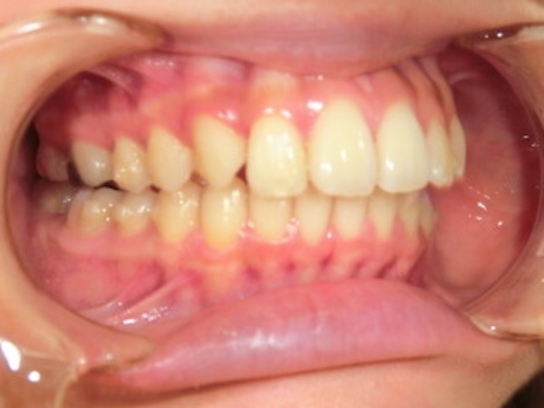 【矯正症例】前歯を内に入れたい　前歯部前突