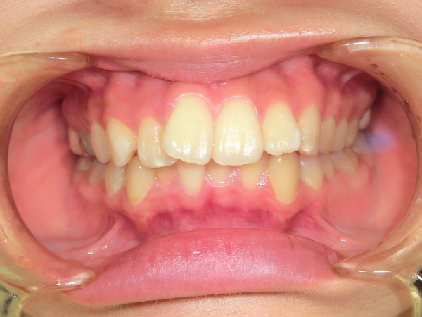 【矯正症例】前歯を内に入れたい　前歯部前突
