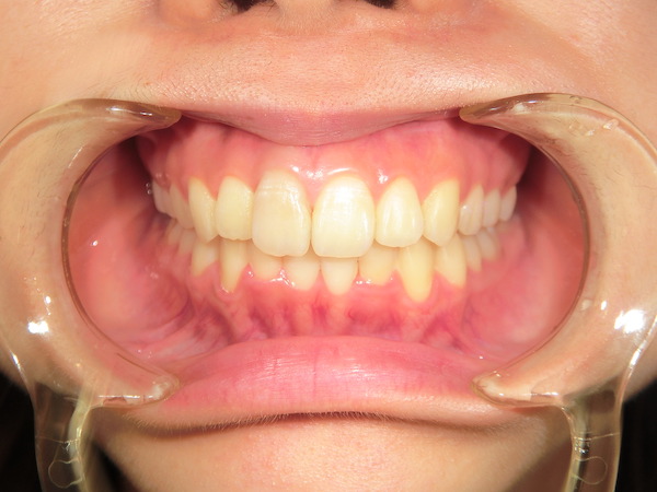 【矯正症例】歯並びをよくしたい　前歯部叢生