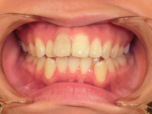 【矯正症例】歯並びをよくしたい　前歯部叢生