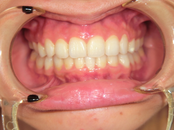 【矯正症例】前歯をきれいにしたい　上顎前突