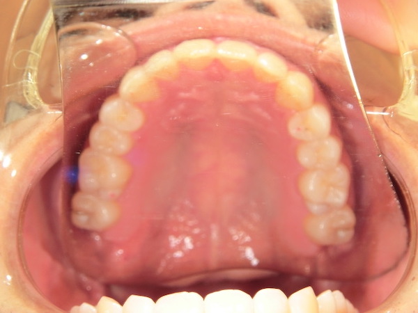 【矯正症例】前歯の凸凹　前歯部叢生