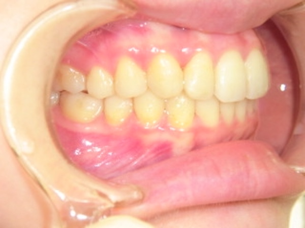 【矯正症例】歯のゆがみを直したい　前歯部叢生