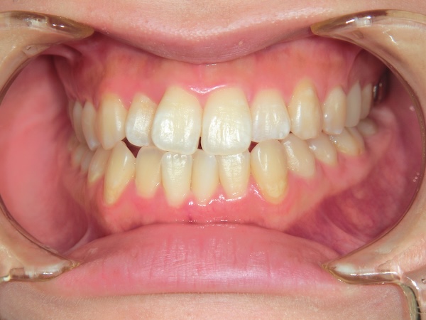 【矯正症例】下の歯が出ている気がする　軽い前歯部反対咬合