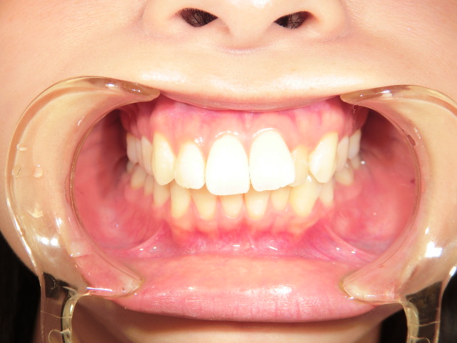 【矯正症例】前歯を内に入れたい　上顎前突