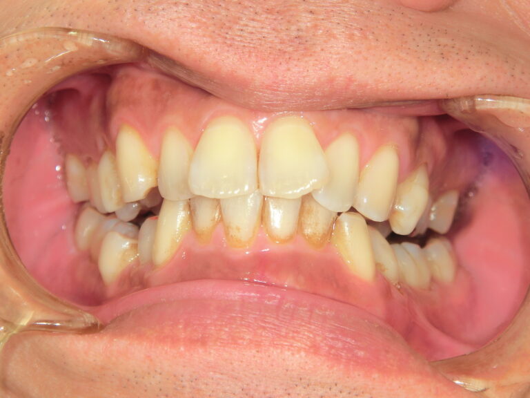 【矯正症例】歯並びをよくしたい　臼歯部咬合不全