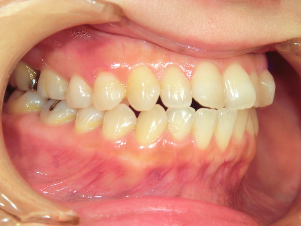 【矯正症例】前歯をそろえたい　前歯部叢生