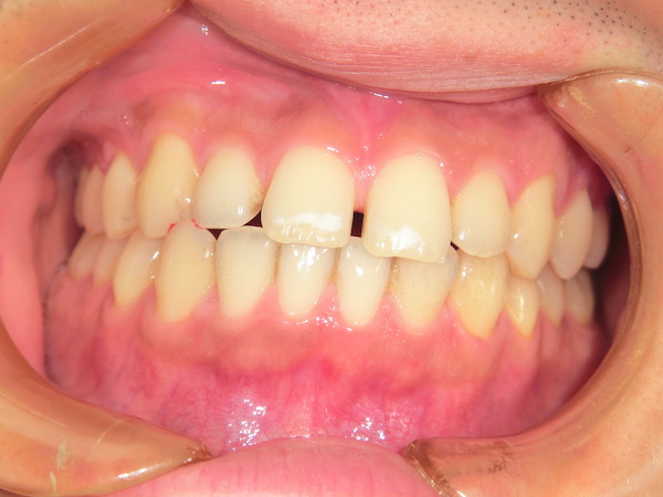 【矯正症例】前歯の隙間を直したい　前歯部離開